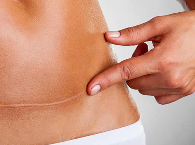 Correção de Cicatrizes Inestéticas