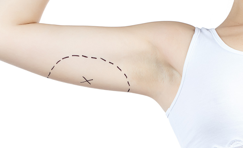 Dermolipectomia Braquial