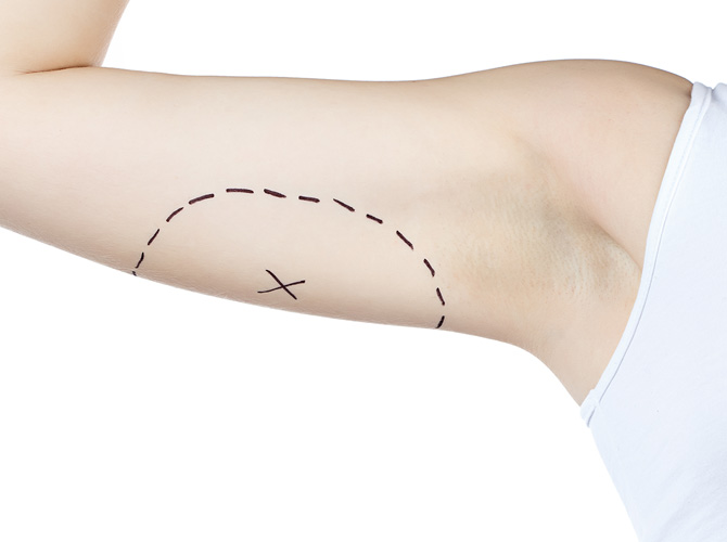 Dermolipectomia Braquial