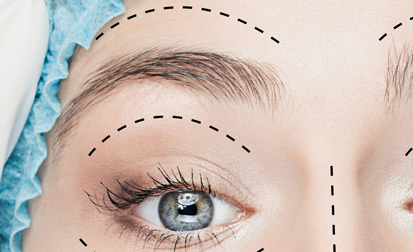 Elevação dos Supercílios