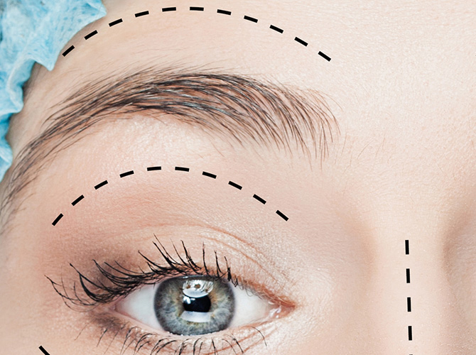 Elevação dos Supercílios