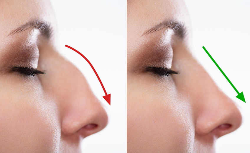 Rinoplastia - Cirurgia plástica do nariz